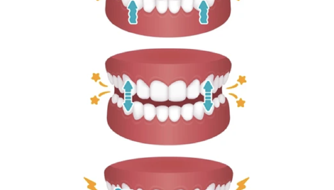 Bruksizam: Efekti stresa i anksioznosti na estetiku zuba
