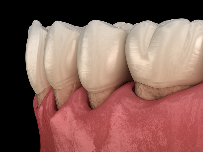 Razotkrivanje parodontoze: razvrstavanje činjenica od mitova